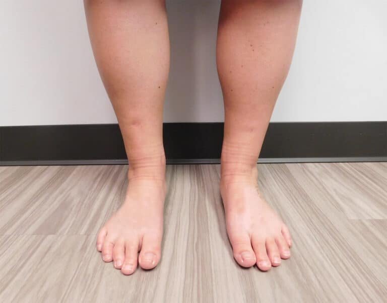 After Image: Liposuction - front