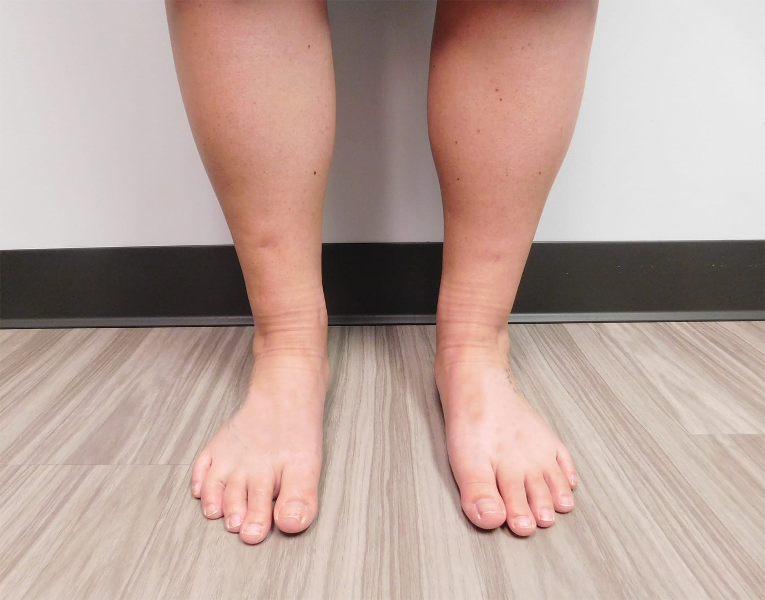 After Image: Liposuction - front