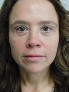 After Image: Blepharoplasty