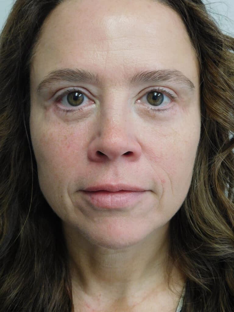 After Image: Blepharoplasty - front