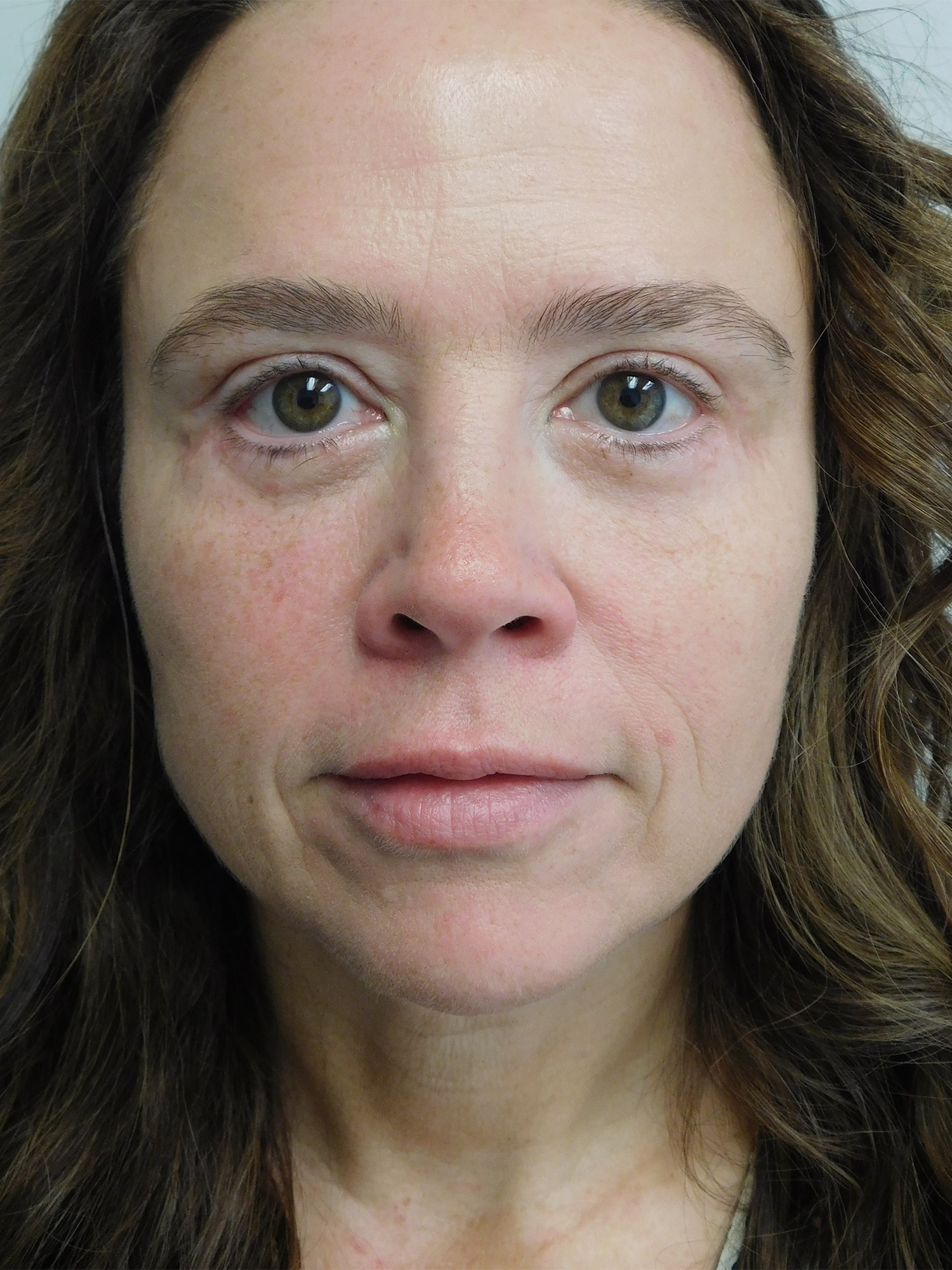 After Image: Blepharoplasty - front