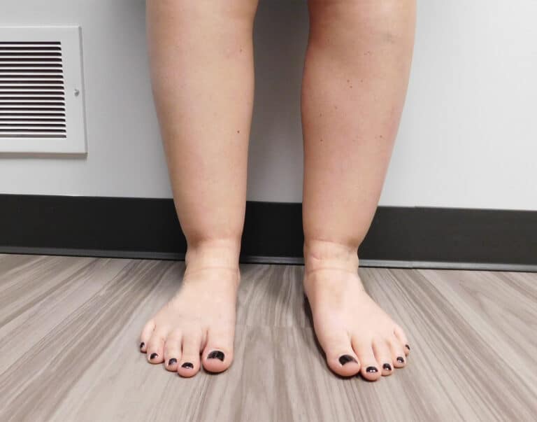 Before Image: Liposuction - front