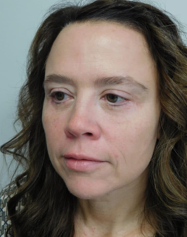After Image: Blepharoplasty - left-front-oblique
