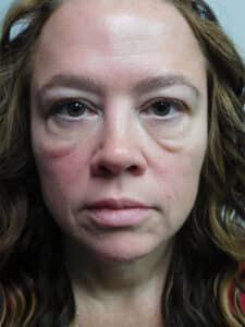 Before Image: Blepharoplasty