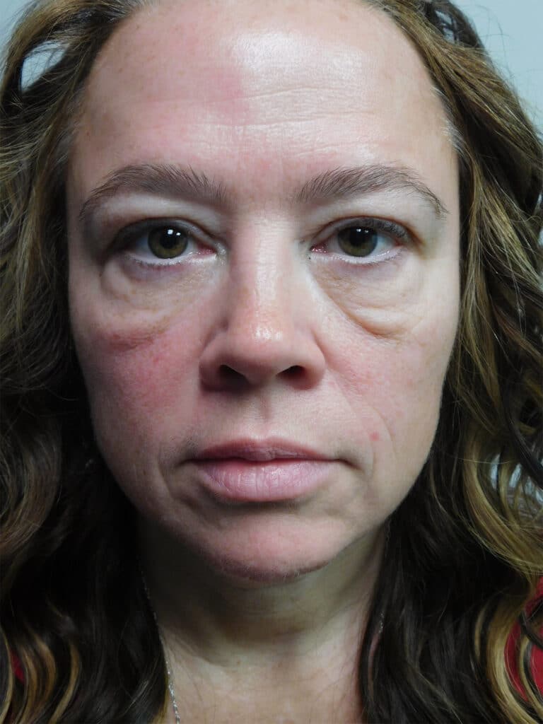 Before Image: Blepharoplasty - front