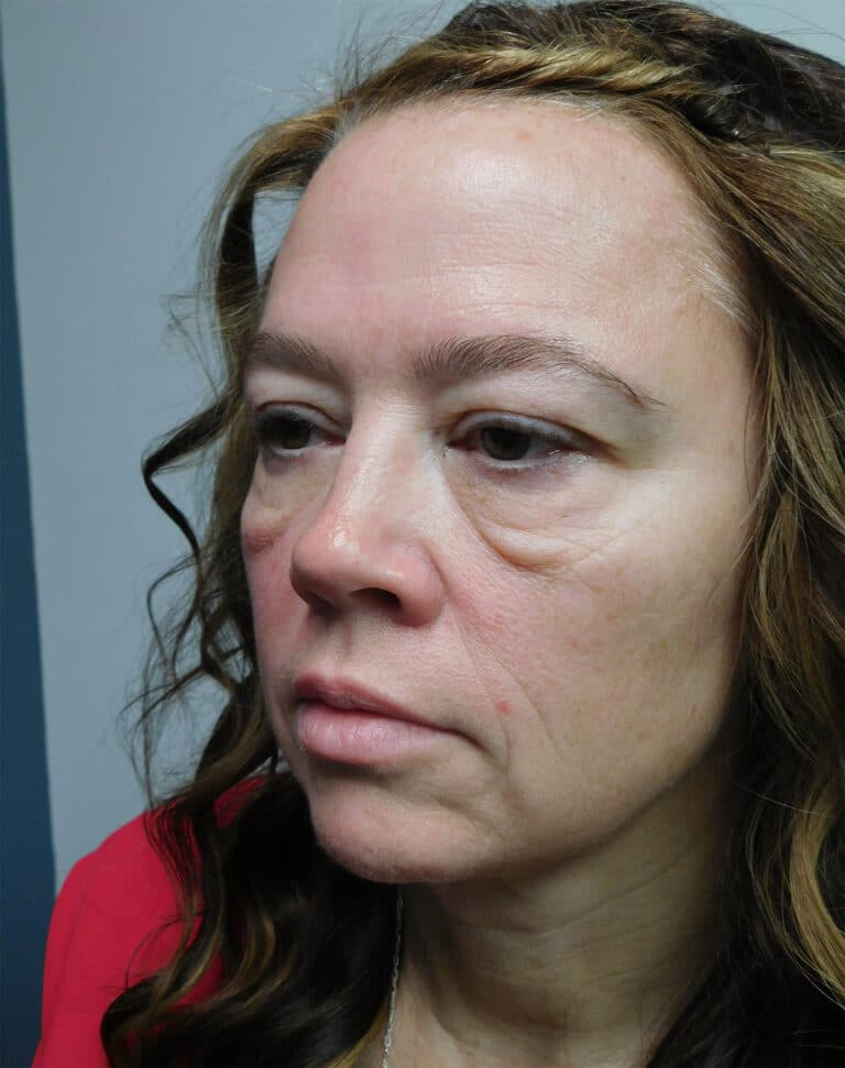 Before Image: Blepharoplasty - left-front-oblique