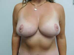 After Image: Breast Reduction