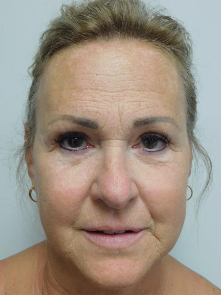 After Image: Blepharoplasty - front