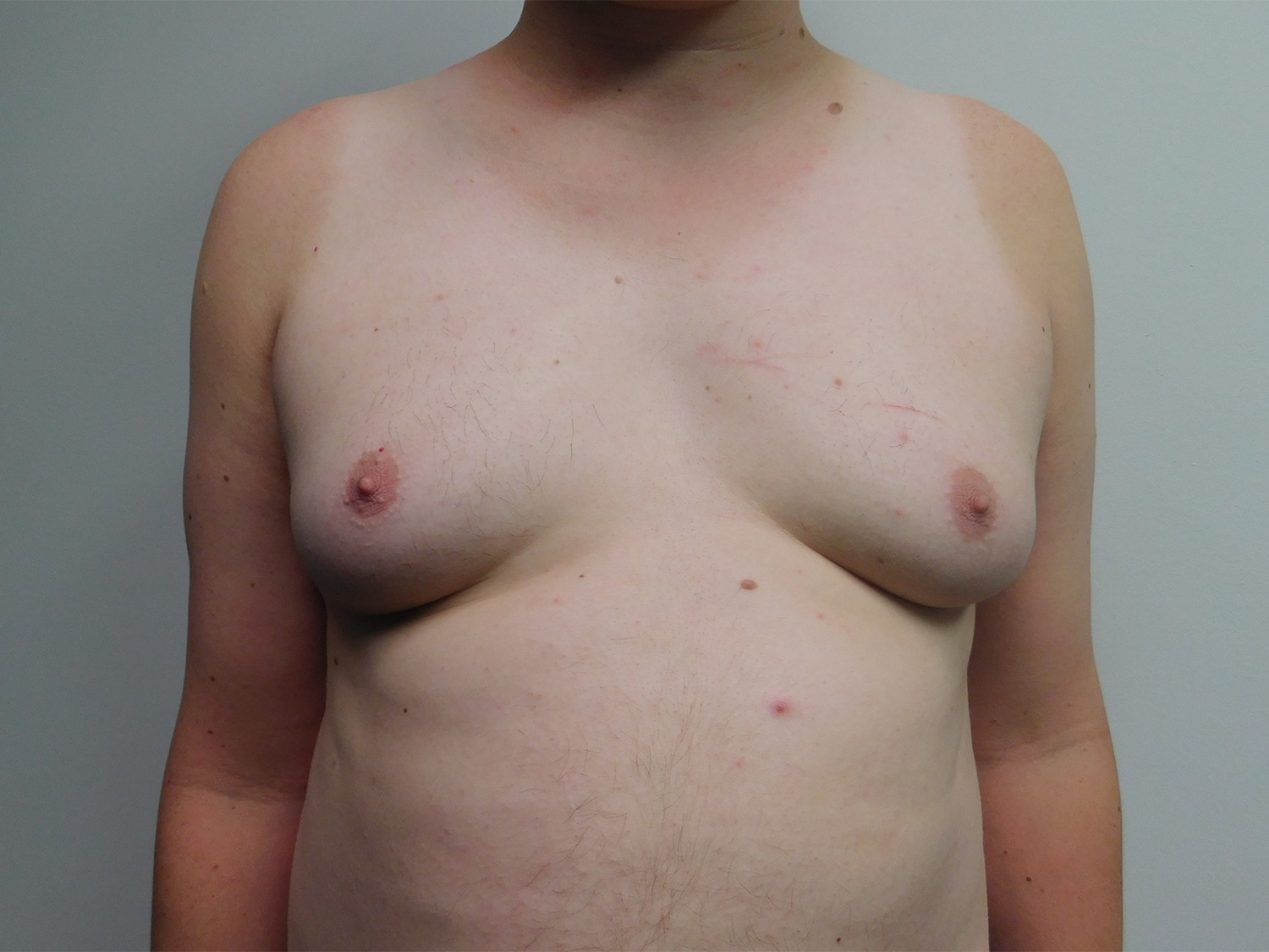 Before Image: Gynecomastia - front