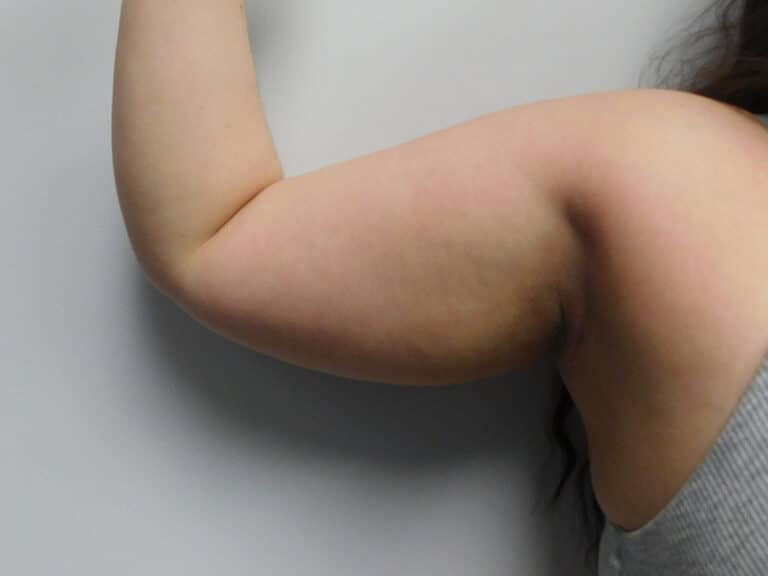 Before Image: Liposuction - front