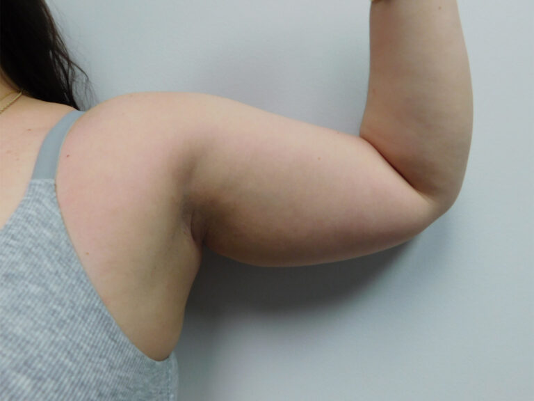 Before Image: Liposuction - front