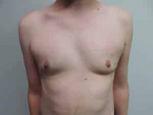 After Image: Gynecomastia