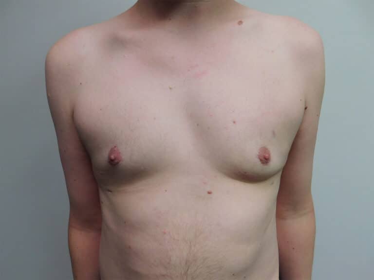 After Image: Gynecomastia - front