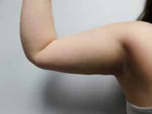 After Image: Liposuction
