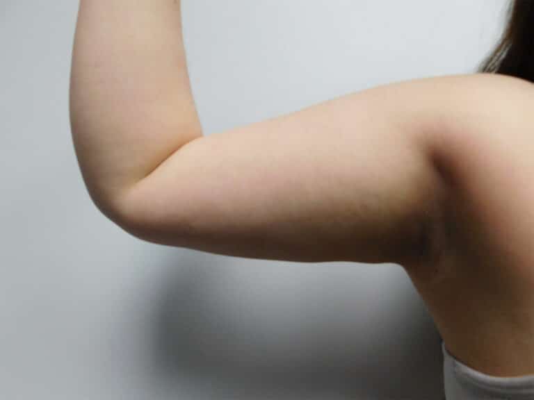 After Image: Liposuction - front