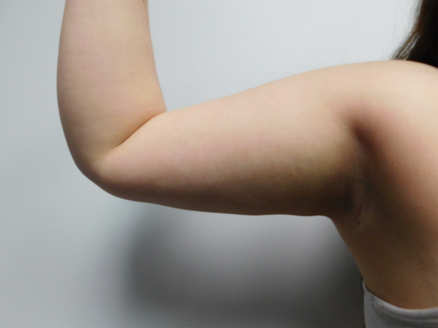 After Image: Liposuction - front