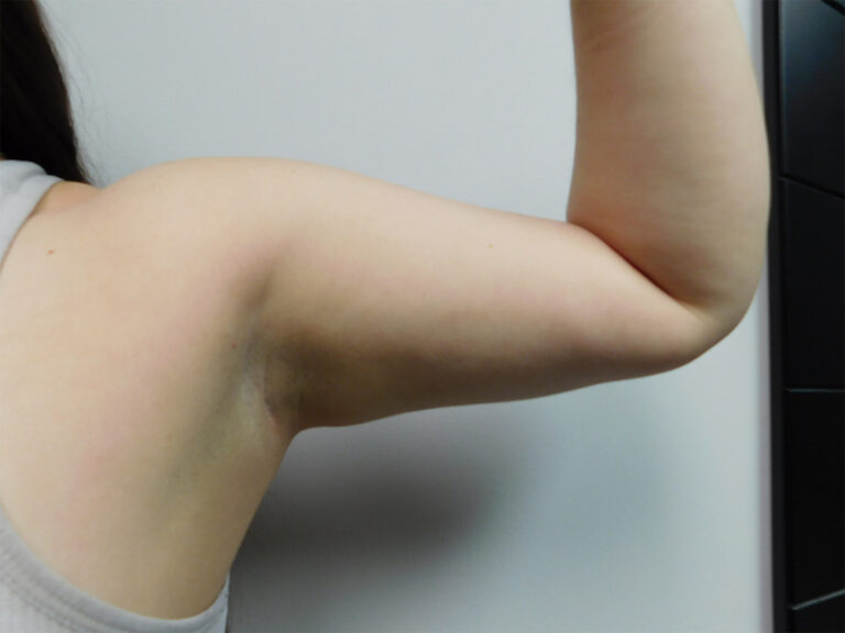 After Image: Liposuction - front