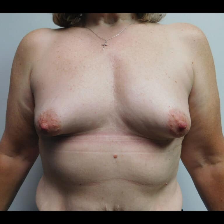 Before Image: Breast Augmentation - front