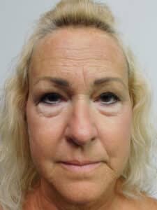 Before Image: Blepharoplasty