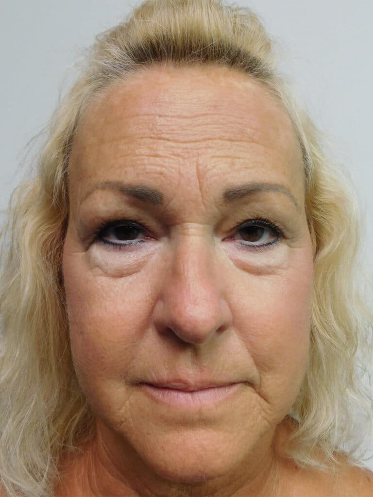 Before Image: Blepharoplasty - front