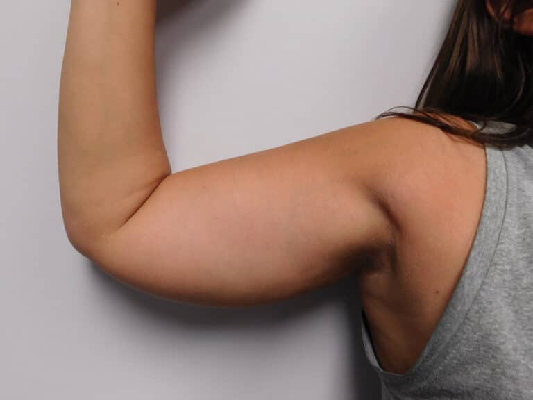 Before Image: Liposuction - front