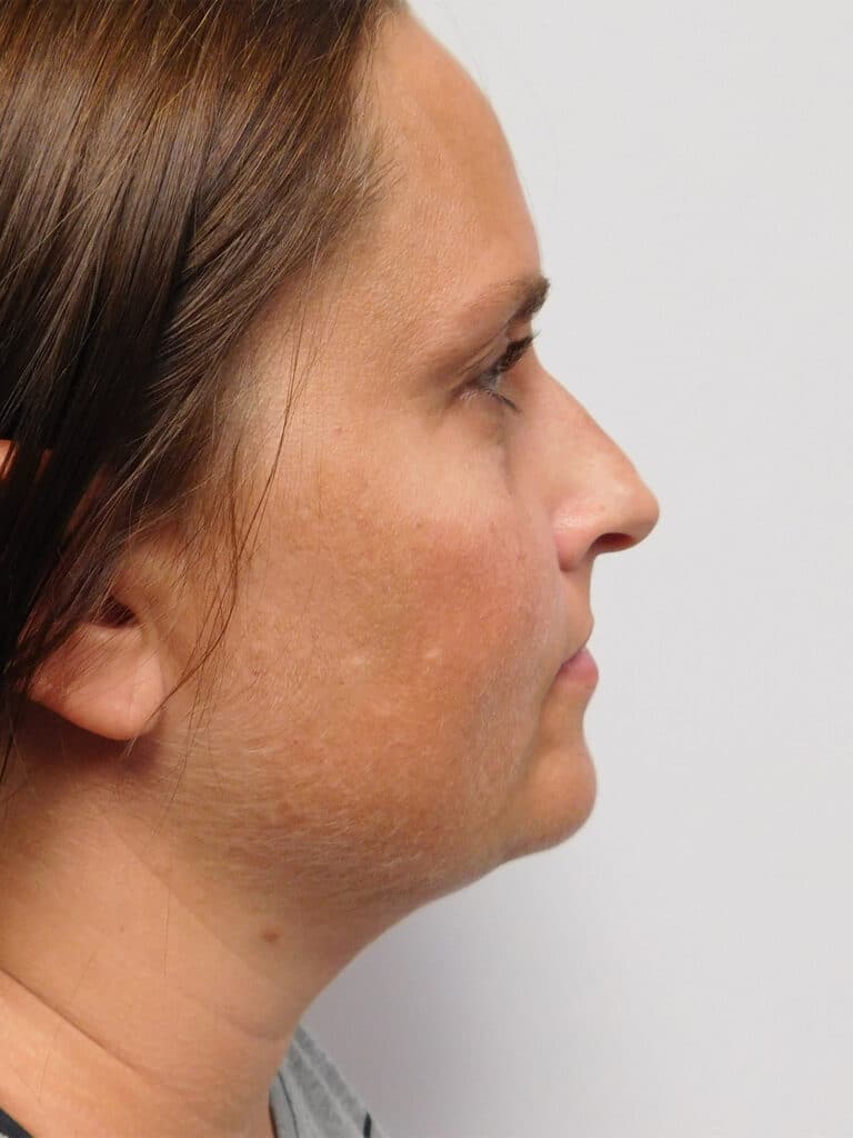 Before Image: Liposuction - right-side