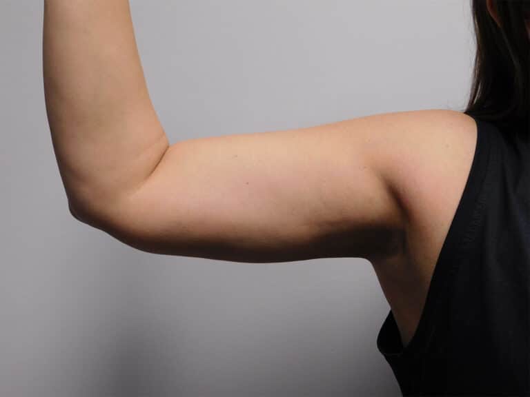 After Image: Liposuction - front