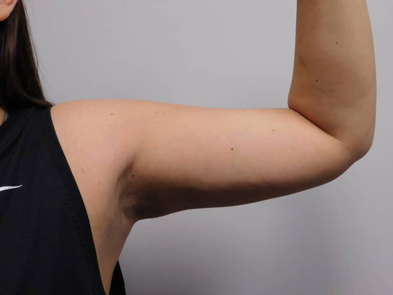 After Image: Liposuction - front
