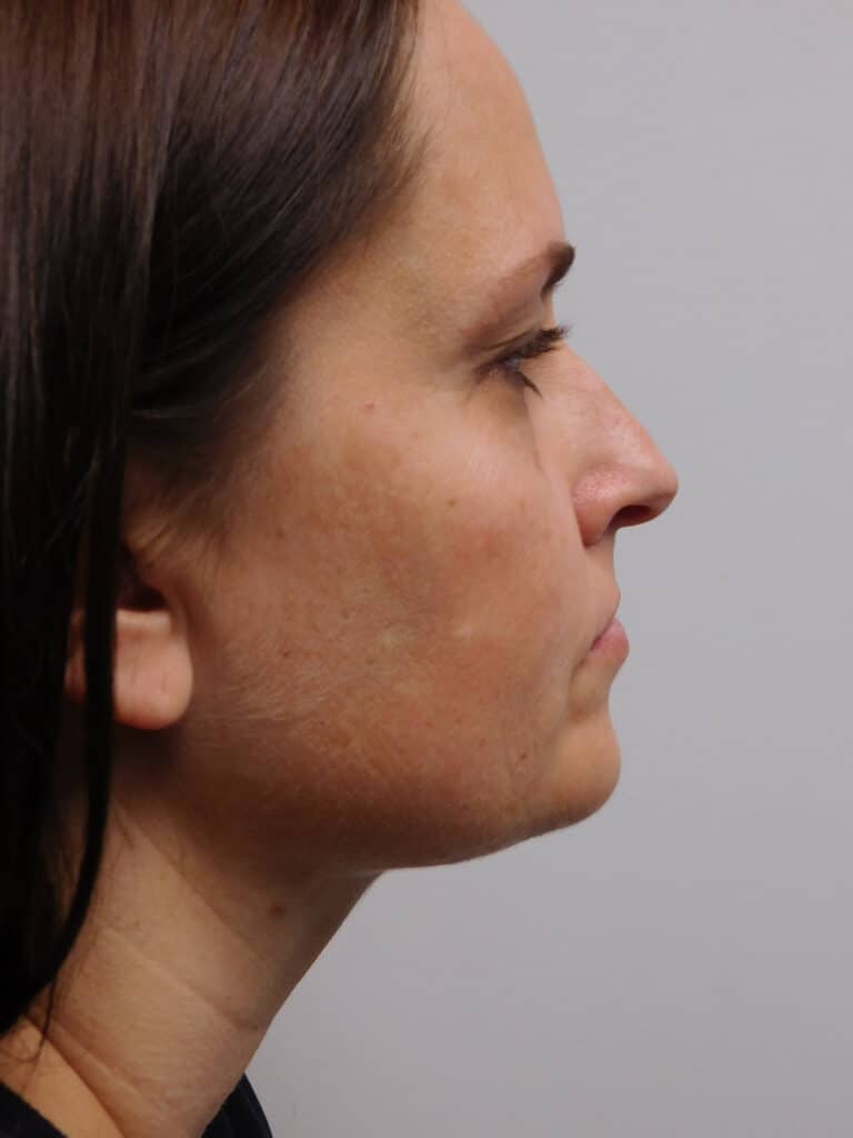 After Image: Liposuction - right-side