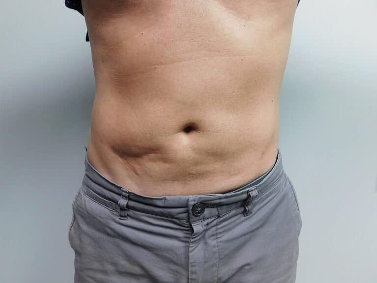 After Image: Liposuction - front