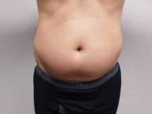 Before Image: Liposuction
