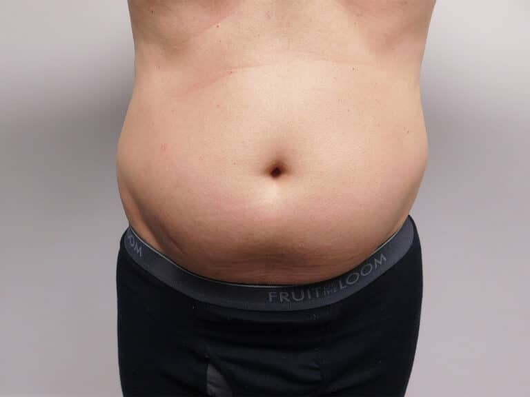 Before Image: Liposuction - front