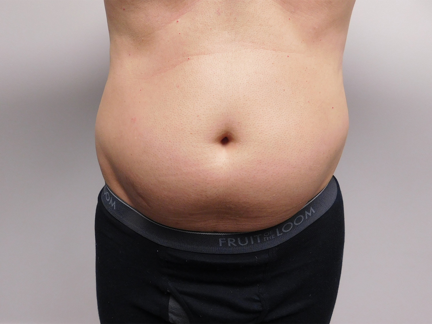 Before Image: Liposuction - front