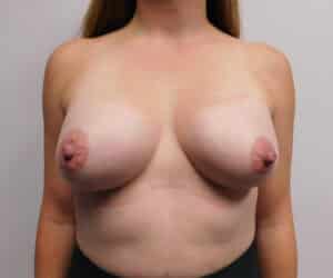 After Image: Breast Augmentation