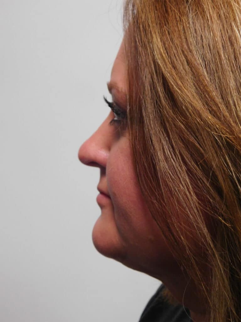 After Image: Liposuction - left-side