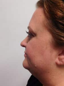 Before Image: Liposuction