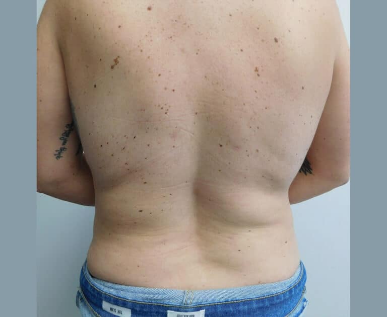 After Image: Liposuction - back