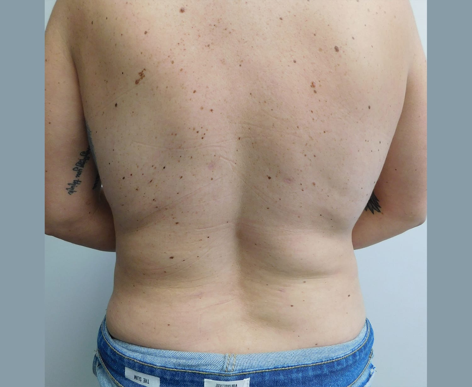 After Image: Liposuction - back