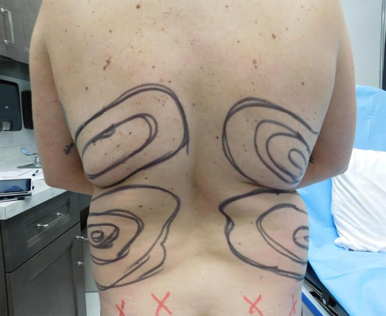 Before Image: Liposuction - back
