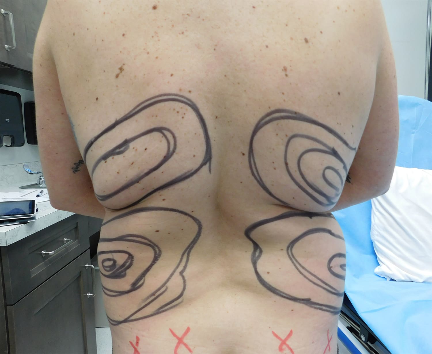 Before Image: Liposuction - back