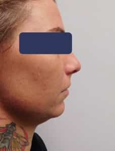 After Image: Chin Implant with Neck Liposuction