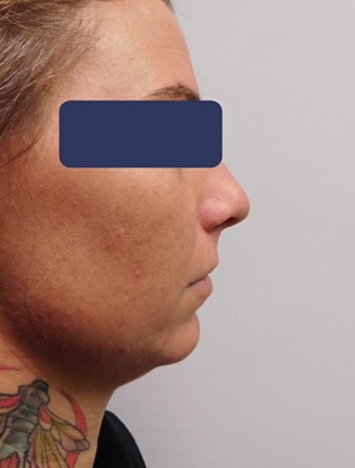 After Image: Chin Implant with Neck Liposuction - right-side