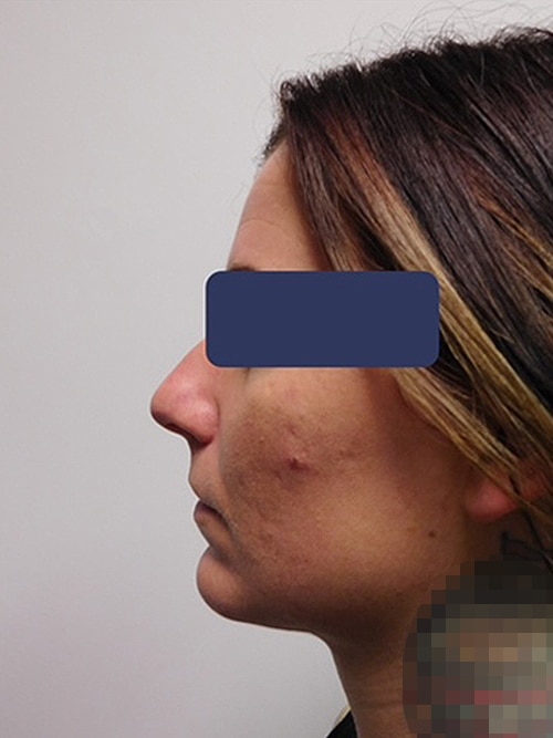 After Image: Chin Implant with Neck Liposuction - left-side