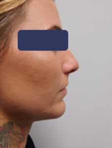 Before Image: Chin Implant with Neck Liposuction