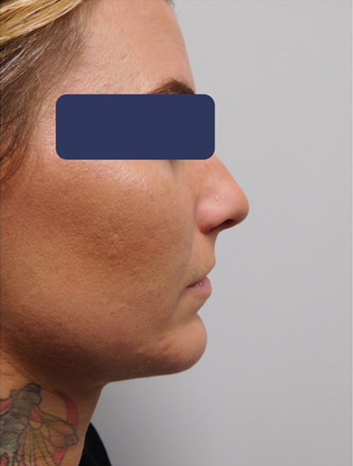 Before Image: Chin Implant with Neck Liposuction - right-side