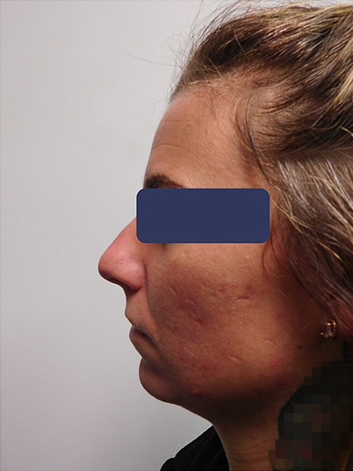 Before Image: Chin Implant with Neck Liposuction - left-side