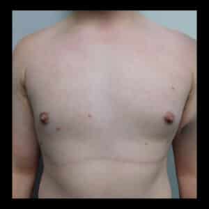 After Image: Gynecomastia