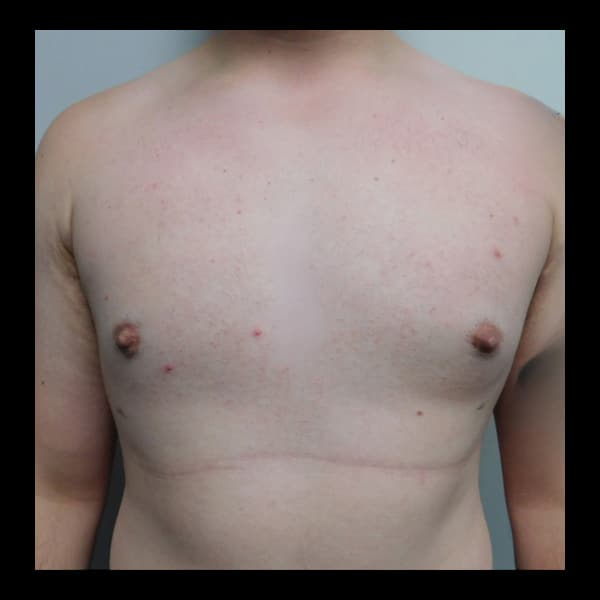 After Image: Gynecomastia - front