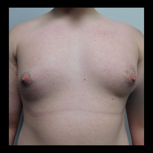 Before Image: Gynecomastia - front