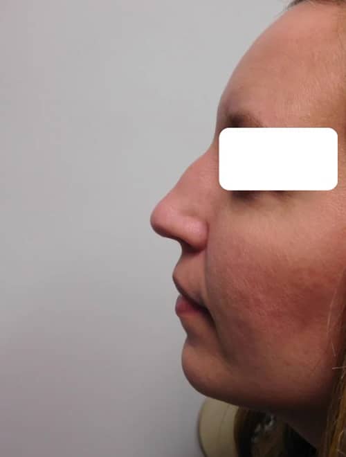 After Image: Rhinoplasty - left-side